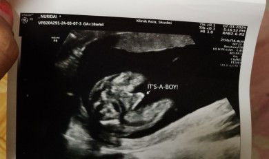 Hallo bun ini Fto usg Debay sya Pas usia 20 Minggu kata dokter JK baby Boy skrng usia kehamilan