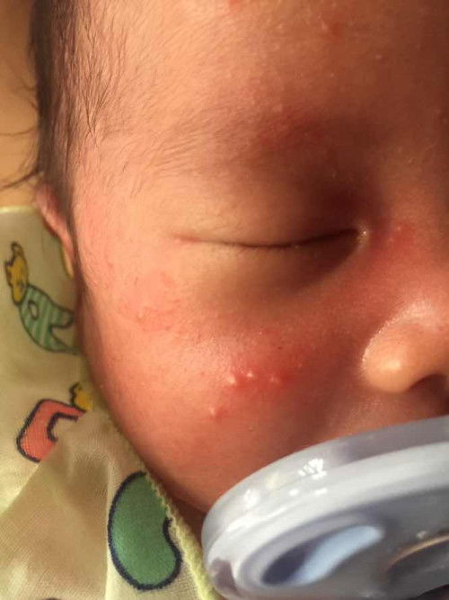 มีตุ่มที่หน้าคือตุ่มอะไรคะแม่ๆ