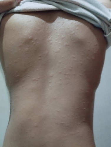 Moms ada yang tahu ga ya ini kenapa dan obatnya apa? Seluruh badan anak saya pada bintik bintik.