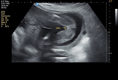 SCAN BABY GIRL??