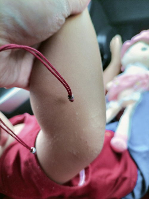 Biji Biji di tangan kaki celah kelangkang.