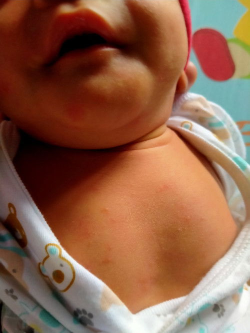 น้อง4วันขึ้นตุ่มแบบนี้ น้องแพ้หรือขึ้นปกติคะ