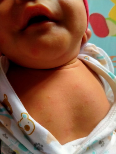 น้อง4วันขึ้นตุ่มแบบนี้ น้องแพ้หรือขึ้นปกติคะ