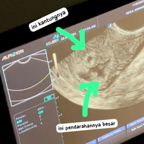 Pendarahan di dalam dan infeksi