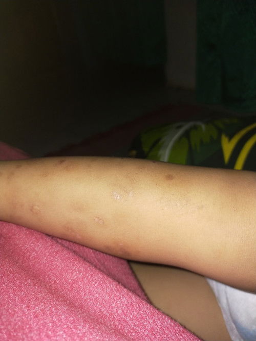 Bagaimana Cara menghilangkan bekas luka?