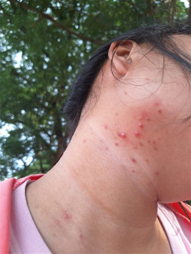 แบบนี้เรียกว่าผื่นหรือเเพ้