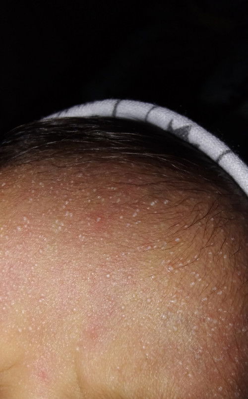 Bintik2 kecil di jidat bayi newbrown kira2 efek apa ya mom