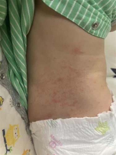 Heat Rash or Ezcema?