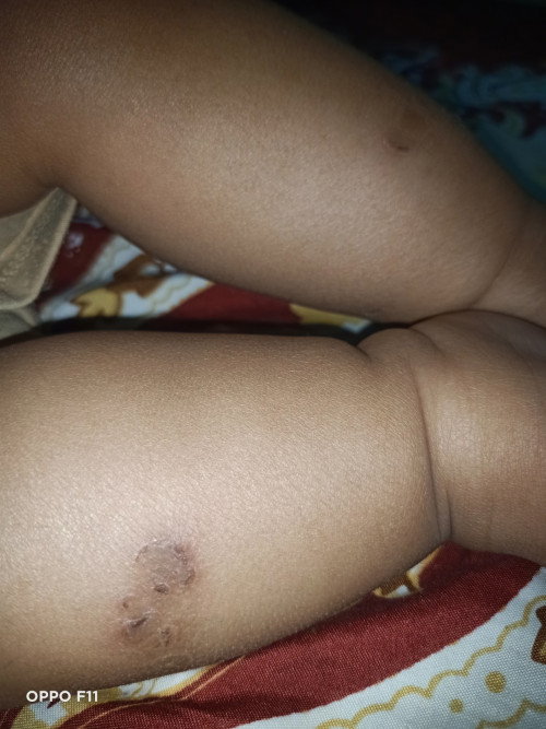 Kulit bayi kering dan luka