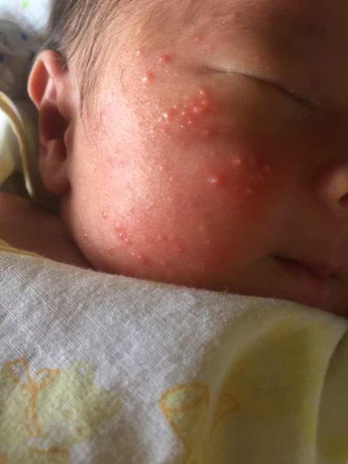 น้อง14วันมีผื่นขึ้นที่หน้า