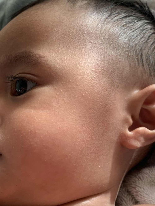 ruam muka bintik bintik