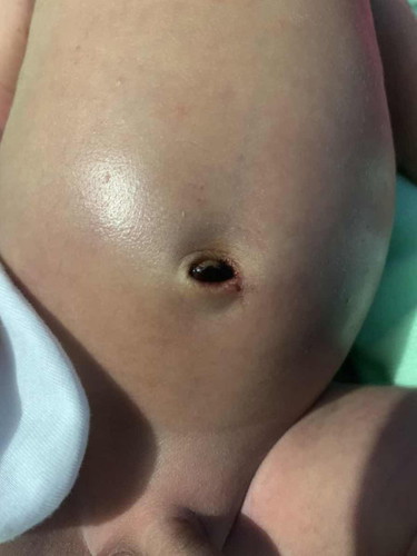 สะดือลูกหลุดแล้วแต่เป็นแบบนี้