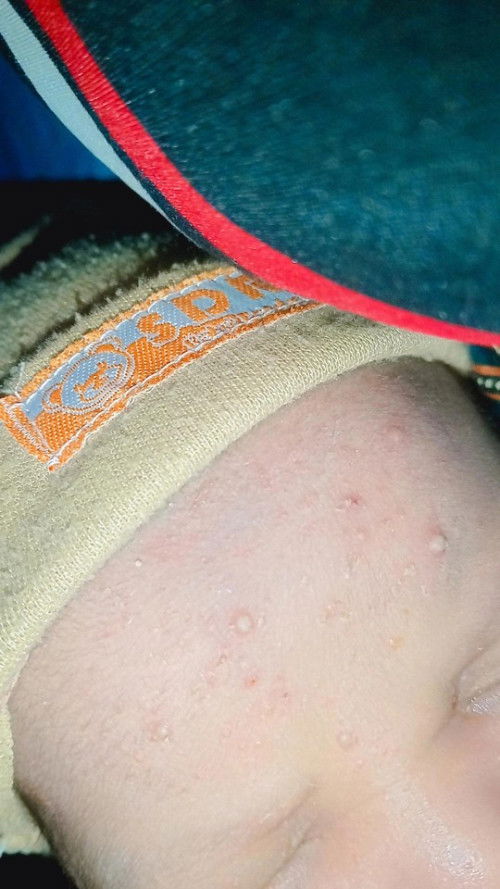 Bunda3 ada yg taukh Ini penyebabnya apa 🙏Anakq baru usia 12 hari di kepalanya di jidat sama belakan