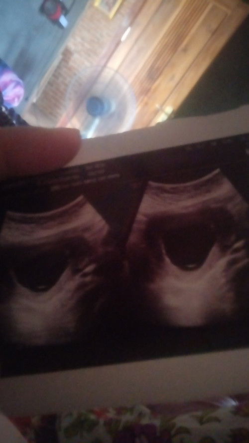 USG berbeda menyebabkan keraguan