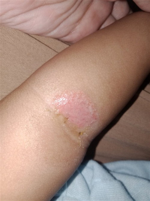 Ruam berair di tangan bayi 3 bulan