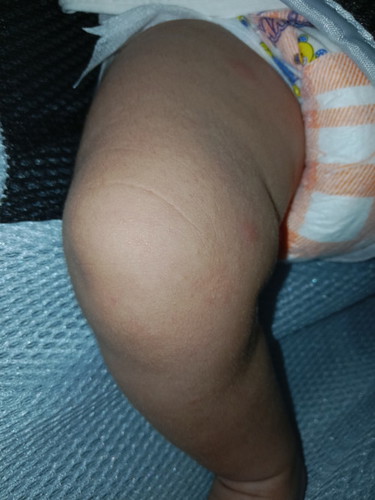 Rashes sa legs
