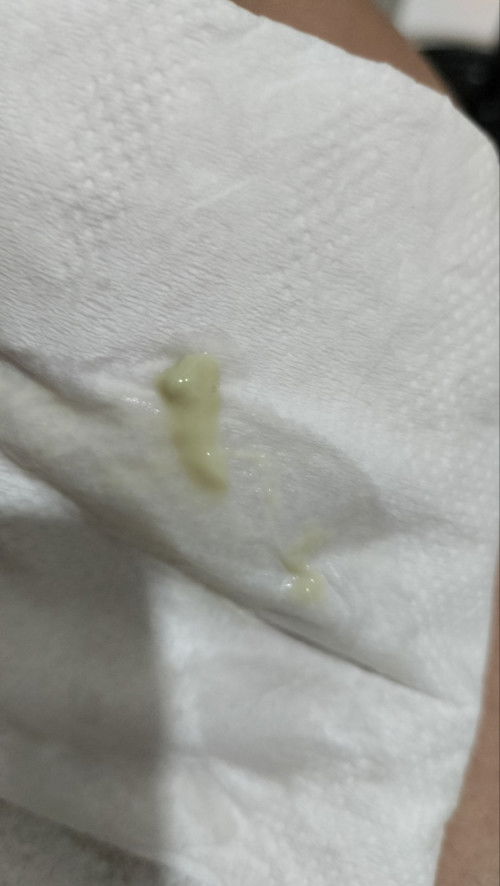 Keputihan Saat Hamil