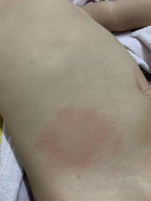 Muncul gatal-gatal setelah imunisasi