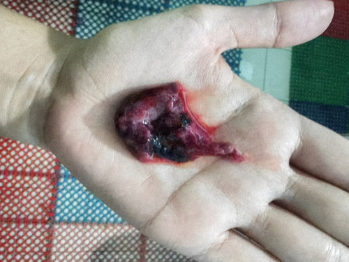 Keluar ketulan darah awal kehamilan