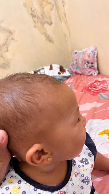 Ubun ubunn bayi terlihat menonjil