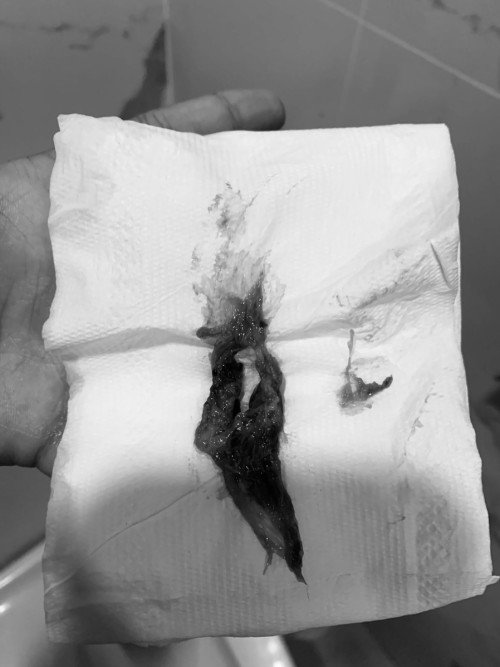 อาการหลังคลอด