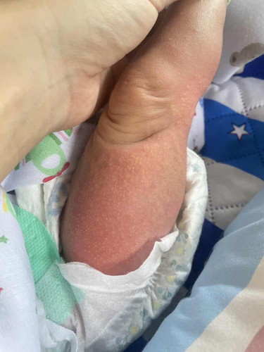 ขาลูกขึ้นผื่นหัวใสๆ นูนๆ ก่อนขึ้นผื่นแบบนี้เป็นปื้นแดงๆก่อน