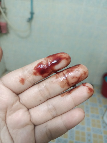 เลือดน้ำตาลปนแดง