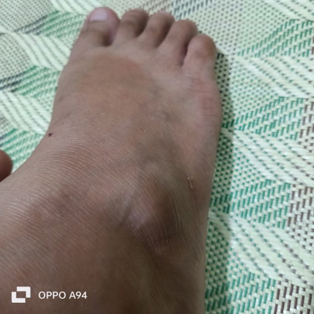 Nadulas ako, ano kaya pwede mangyari sa paa ko na namamaga ngayon?