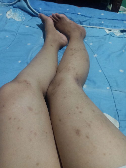 Gatal gatal seluruh badan