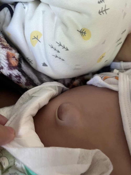 ทารกสะดือปูด