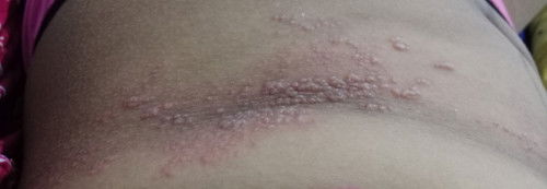 Herpes saat menyusui