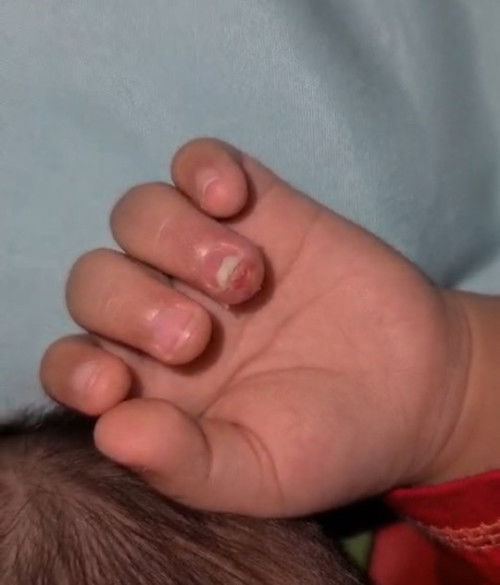 Jari anak lenting berair kecil dan merah