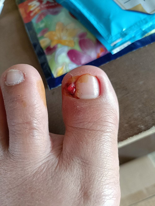 Fingertoe infection during pregnancy