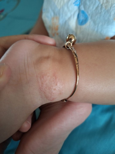 น้องบ้านไหนเคยผื่นขึ้นแบบบนี้มั้ยค่ะ