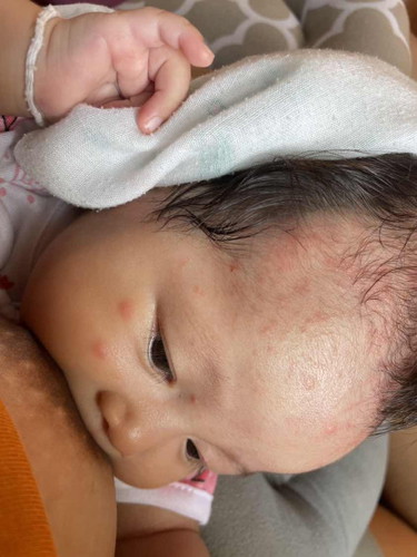 ลูก 2เดือนขึ้นผดแบบนี้เป็นอะไรรึป่าวคะแม่ๆ