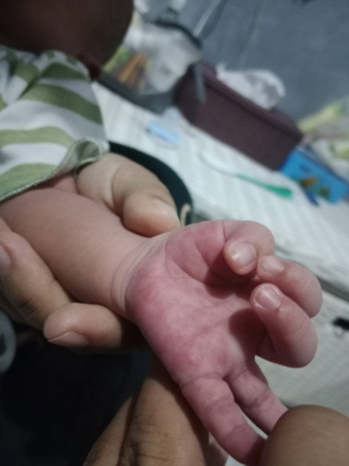 Bentol tangan kaki