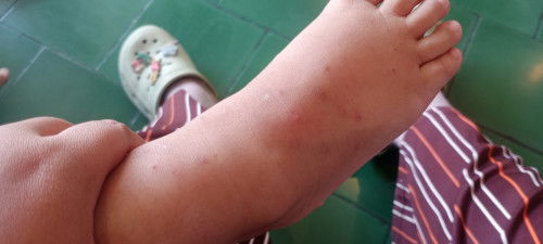 Bintik bintik berair pada anak 3 th