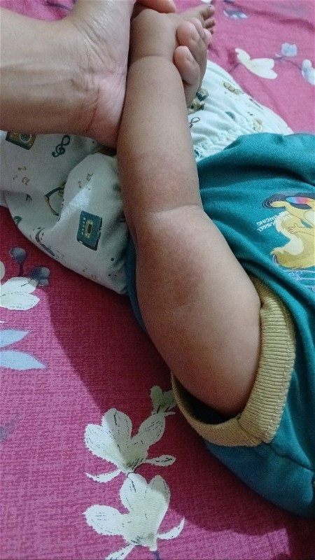 Ruam merah ditangan 🥹
