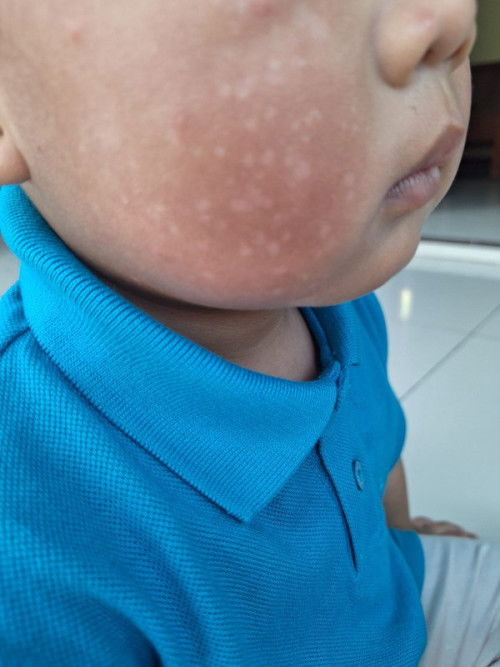 Bintik putih di pipi