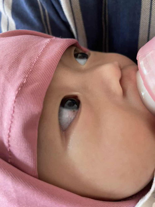 Benda asing pada mata bayi