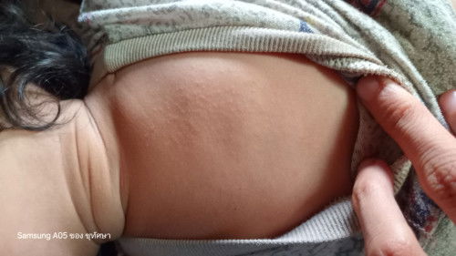 เป็นผืดหรือผด