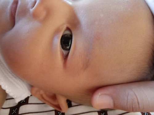 Bercak putih diujung kulit bgian mata