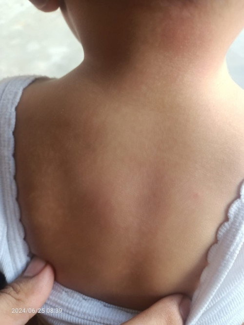 Bercak putih di punggung bayi