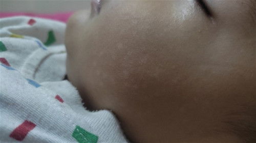 Pipi muncul bintik bintik putih