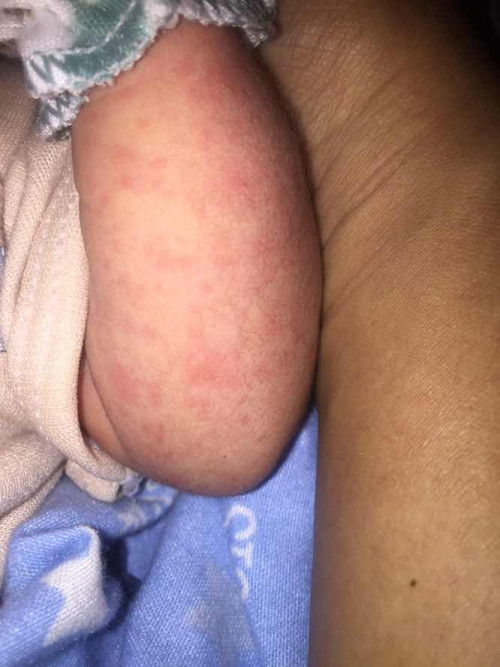 NB usia 5 hari kulit tangan bintik merah