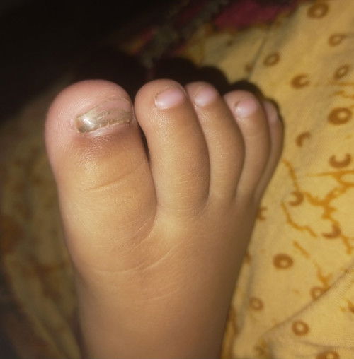 Kuku rapuh berubah warna