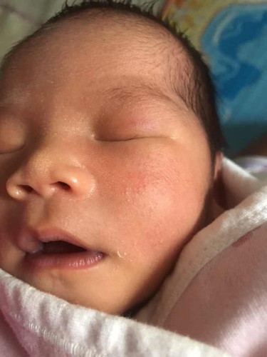 ผื่นขึ้นที่แก้มน้อง