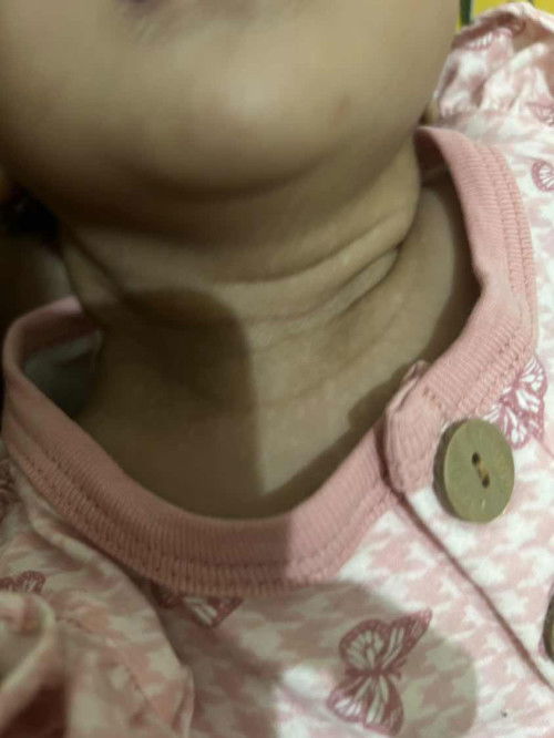 BERCAK PUTIH DILEHER BABY