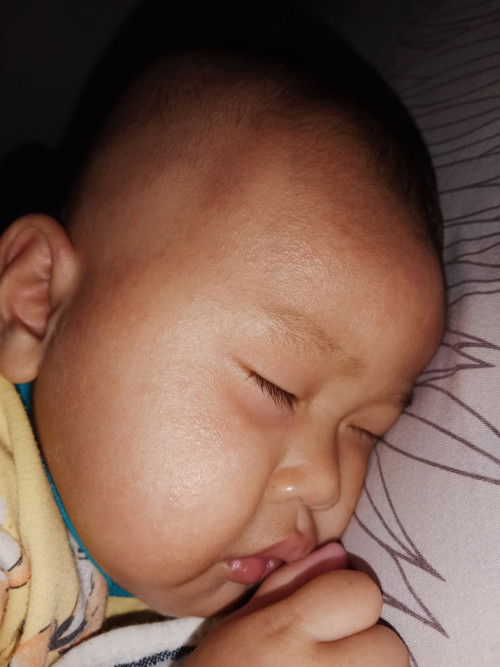 Ruam atau biang keringat