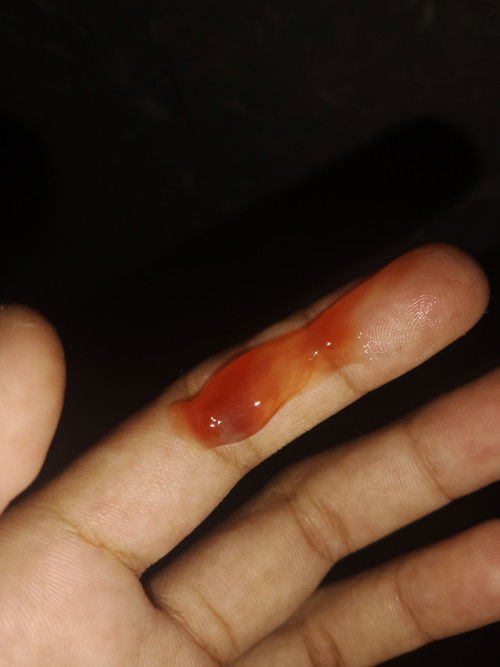 โดนกระตุ้นปากมดลูกมา แล้วมีมูกเลือดไหล แบบนี้ไปหาหมอเลยมั้ยค่ะ